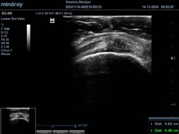 Ultrasound image showing healed rotator cuff tendon after shoulder injury treatment in Zagreb