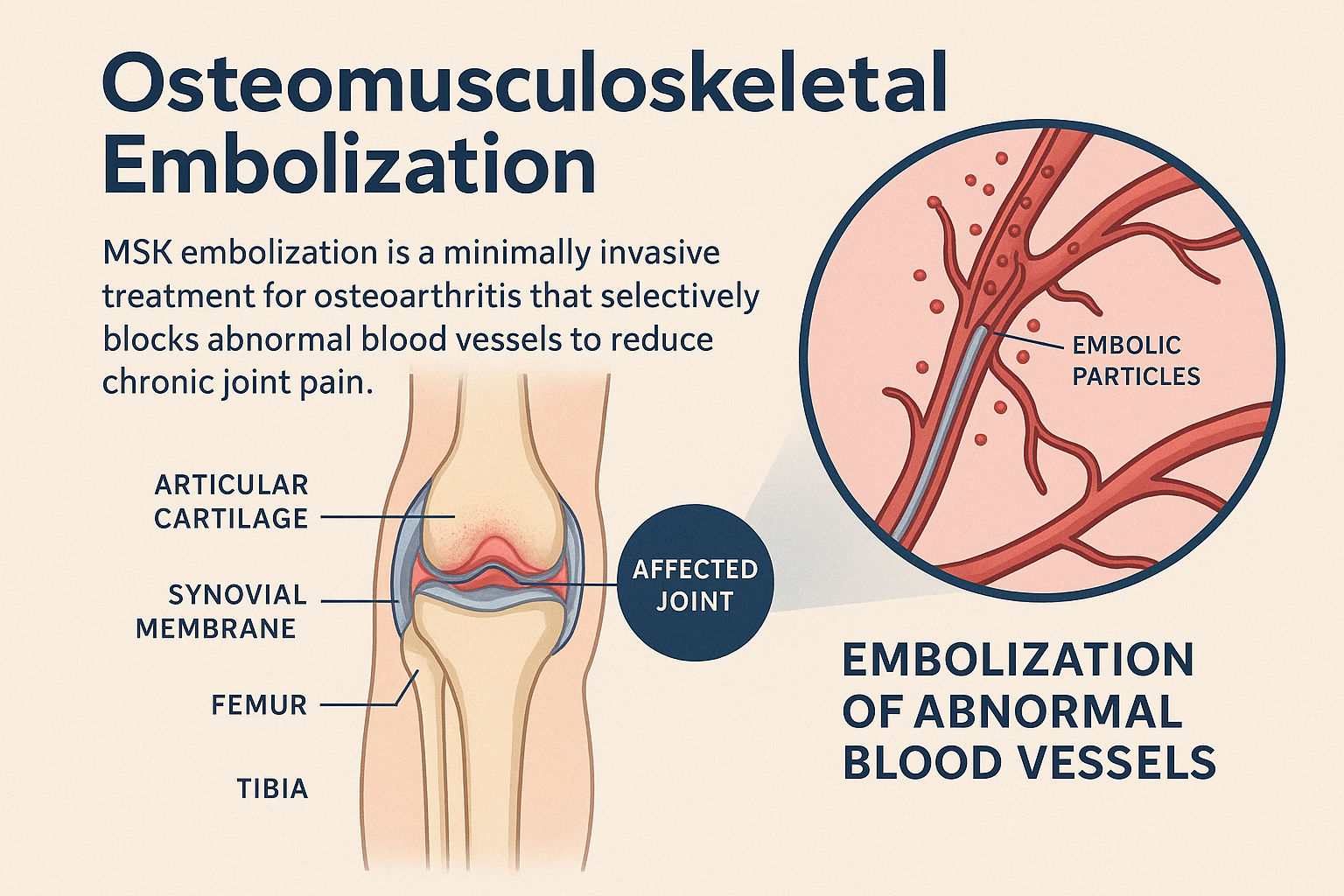ZagrebMed - Osteoarthritis Pain Relief with MSK Embolization – Book ...