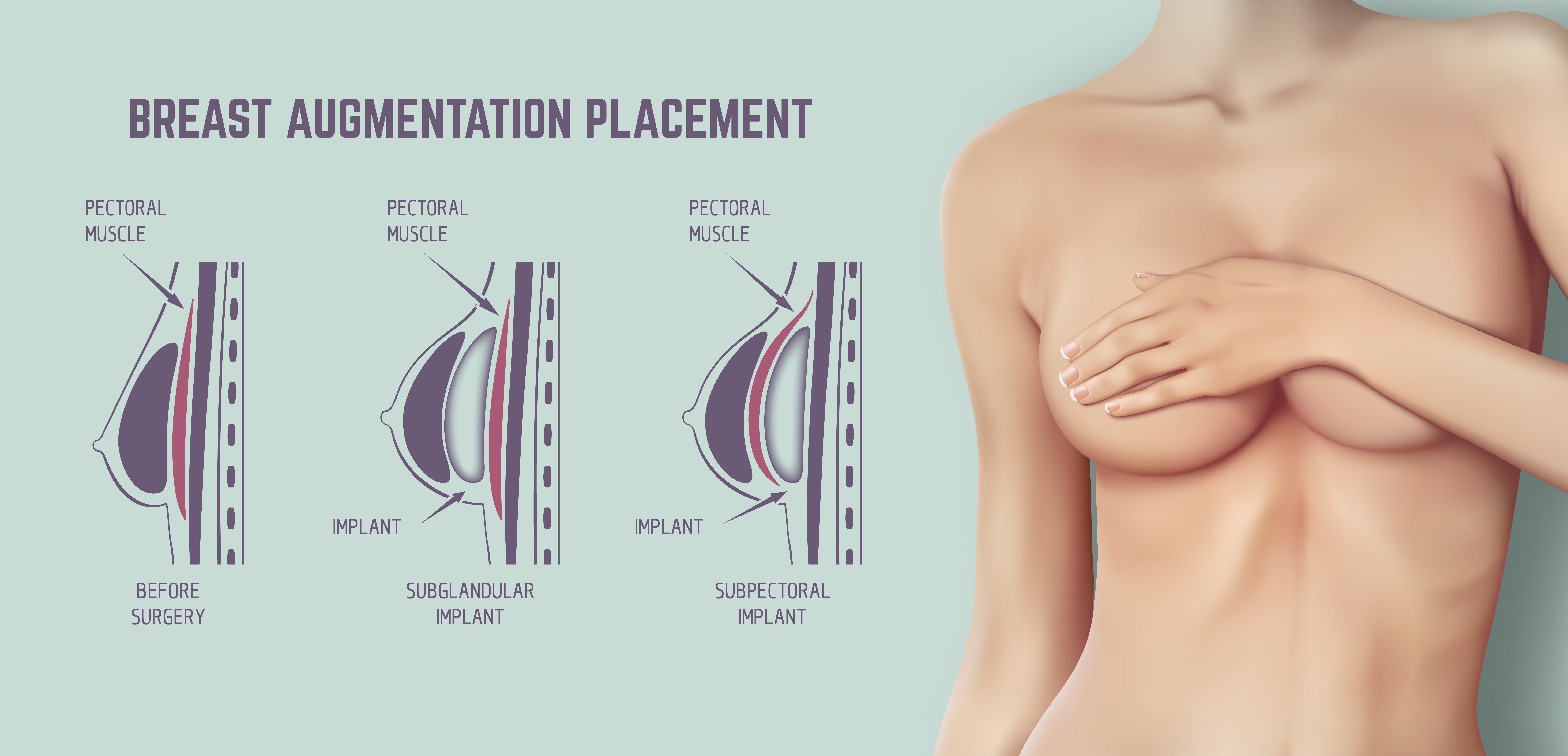 Breast augmentation in Zagreb