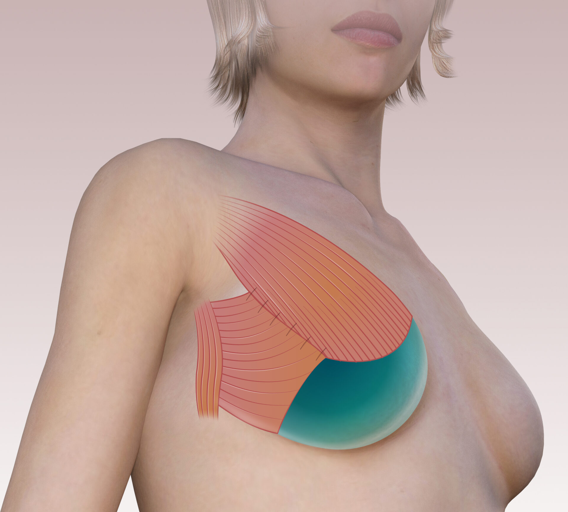 Truths and myths on breast reconstruction
