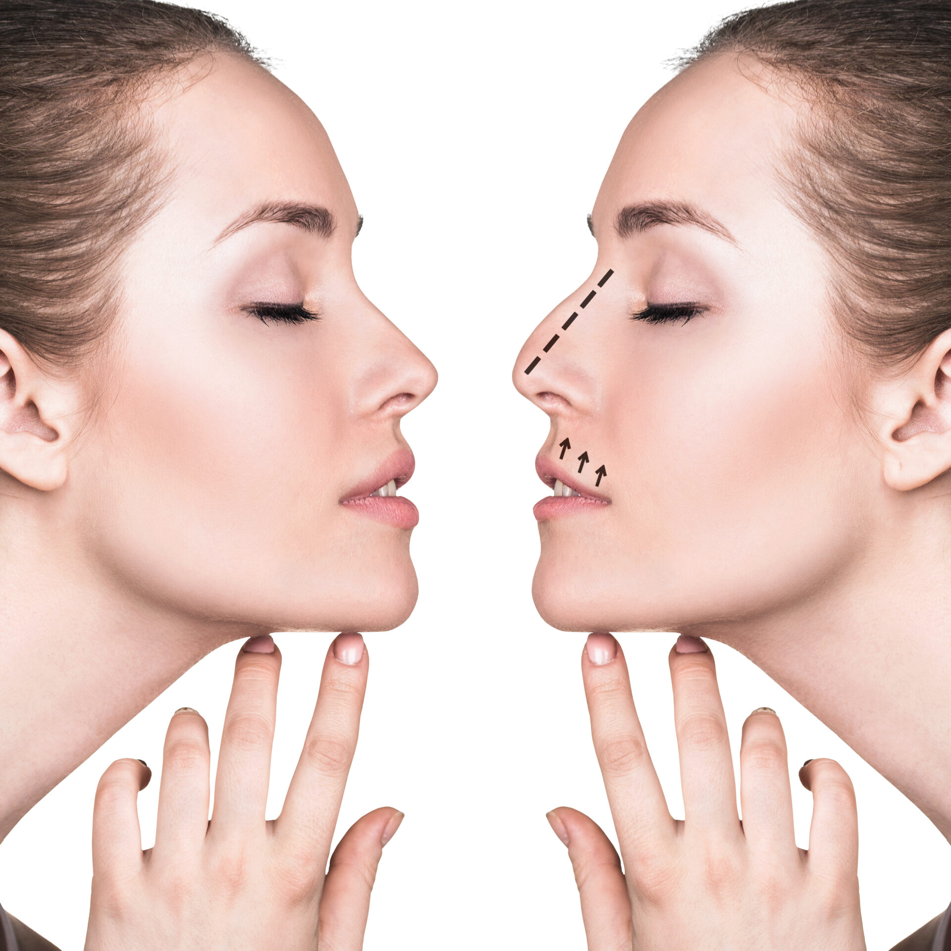 Rinoplastica e settoplastica: esiste una connessione?