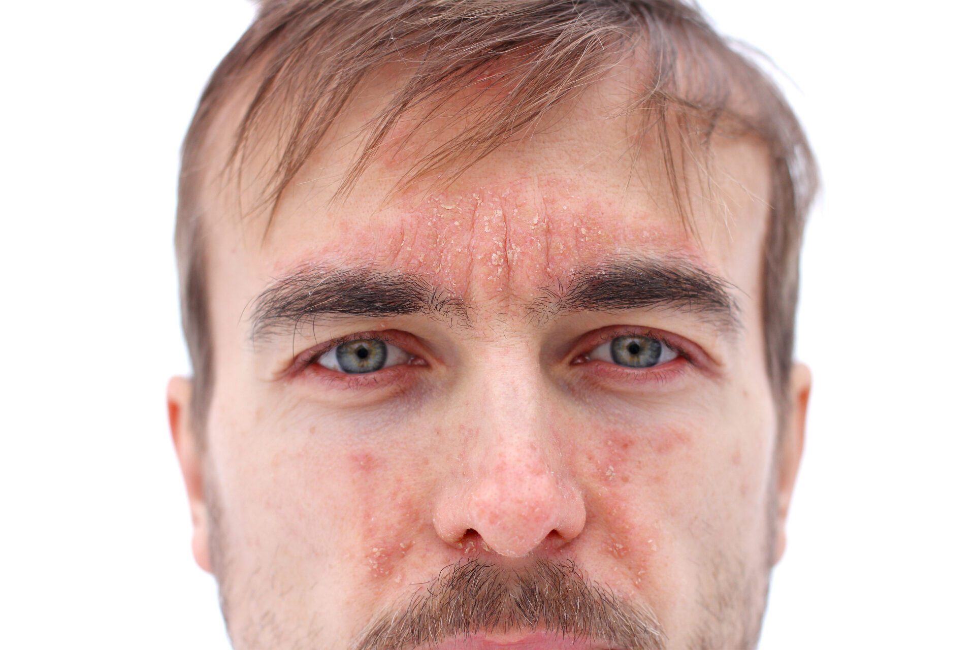 Alternative Behandlungen für Psoriasis